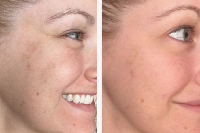 Before & After